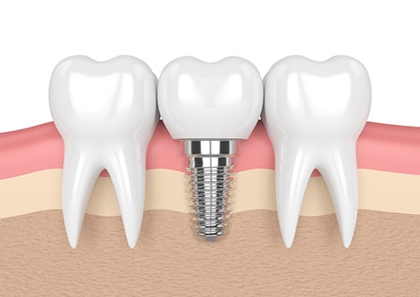 Implant Picture